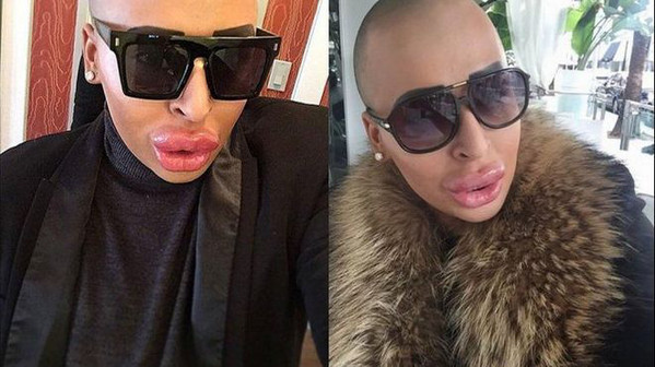 Hombre gasta $150.000 en cirugias para parecerse a Kim Kardashian